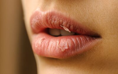 La descamación labial